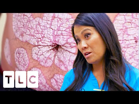 Man&rsquo;s Skin Thinks HE is a Virus! Severe Psoriasis Leaves a Dust Trail Behind | Dr Pimple Popper