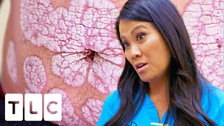 Man's Skin Thinks HE is a Virus! Severe Psoriasis Leaves a Dust Trail Behind | Dr Pimple Popper