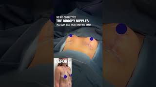 Another Droopy Perky Transformation After Breast Lift And Augmentation