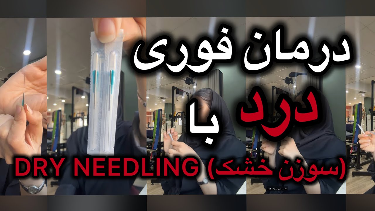درای نیدلینگ چیست؟معجزه سوزن خشک در فیزیوتراپی(درمان فوری گرفتگی شانه و خداخافظی با گره عضلانی) !