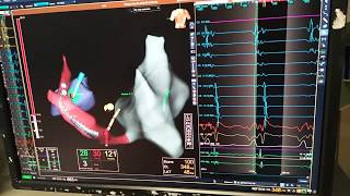 Left lateral accessory pathway ablation - decoded