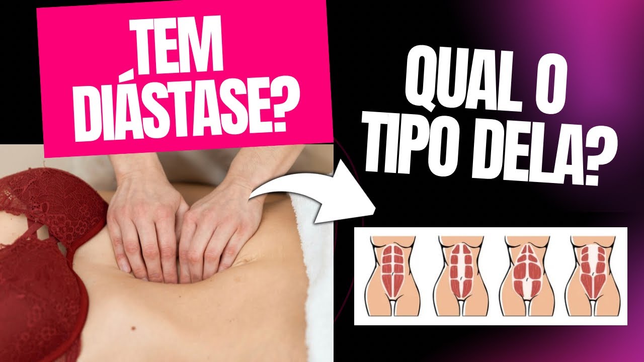 COMO DESCOBRIR SE VOCÊ TEM DIÁSTASE ABDOMINAL E QUAL O TIPO DELA (teste em casa)