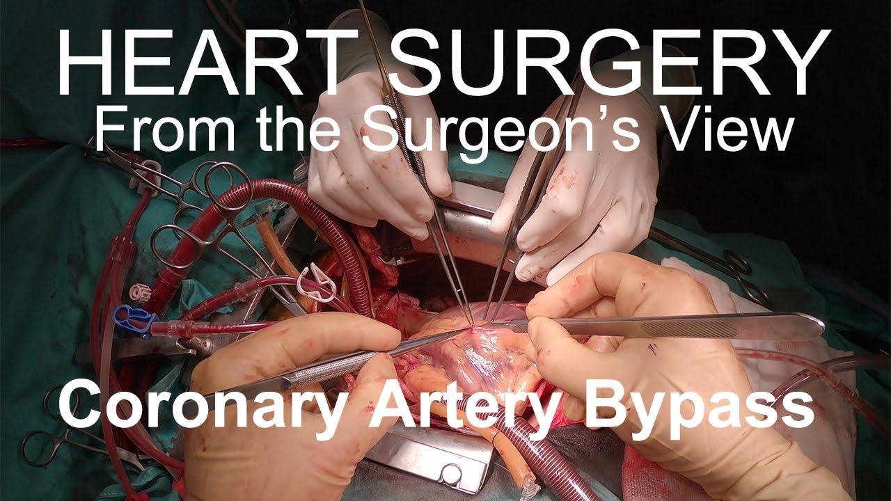 Heart Surgery