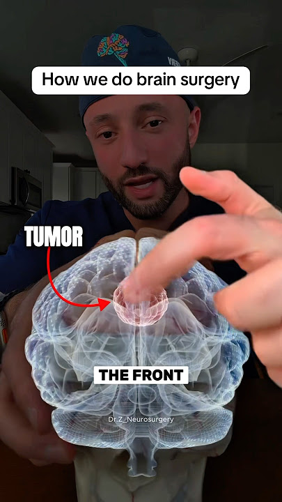 This is how we remove a brain tumor. 🧠 #neurosurgeon #neurosurgery #medical #doctor #surgery
