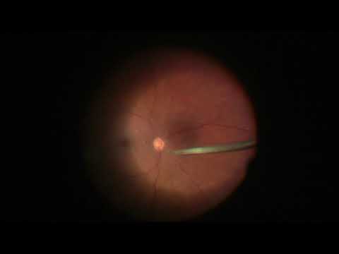 Video: Pembekuan Laser Retina