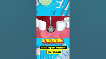 Dental implant procedure. Quy trình cắm trụ IMPLANT. #nhakhoauytin #dentist #nhakhoabinhduong #xhhh
