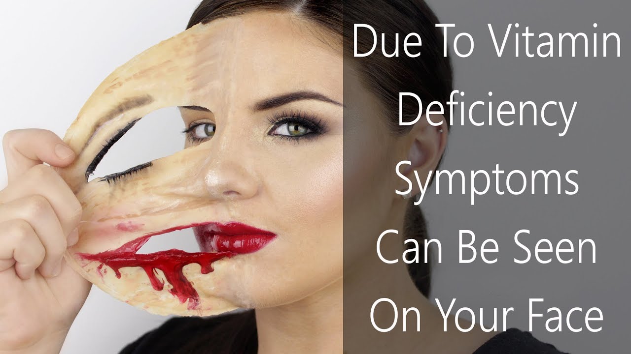 6 SYMPTOMS THAT CAN BE SEEN ON YOUR FACE DUE TO VITAMIN DEFICIENCY