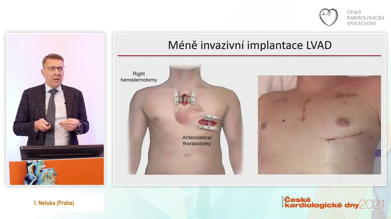 video: Nov guidelines ESC 2021  srden selhn (blok sponzorovan spolenost Novartis s.r.o.)