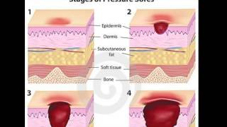 Pressure Sores