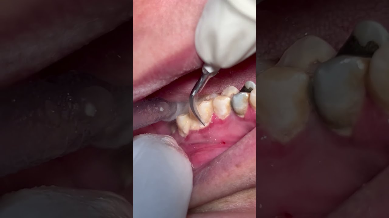Scaling Teeth From Tartar And Calculus Dental Satisfying