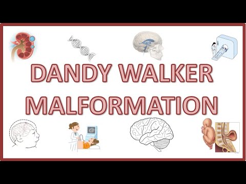 Дэнди Уокерын хам шинж - Шалтгаан, шинж тэмдэг, шинж тэмдэг, эмгэг физиологи, оношлогоо
