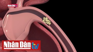 "Đẩy" sỏi thận, phải đúng cách | Sống khỏe