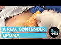 A Real Contender Lipoma