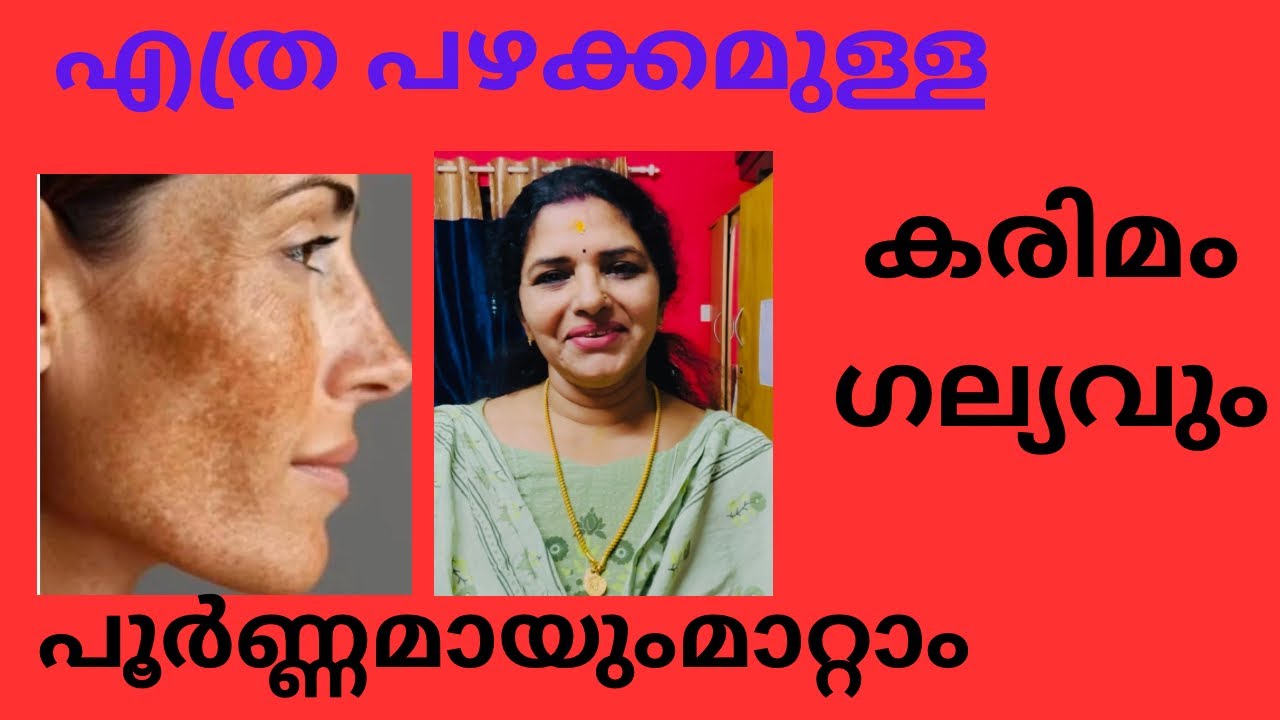 കരിമംഗല്യം മാറ്റാൻ ഈ ഒരു packമാത്രം ഇട്ടാൽ മതി 