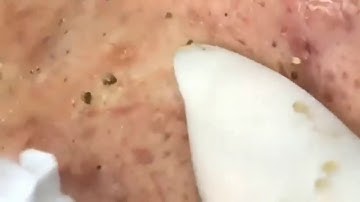 Blackheads    LARGE Blackheads Removal   Best Pimple Popping Videos