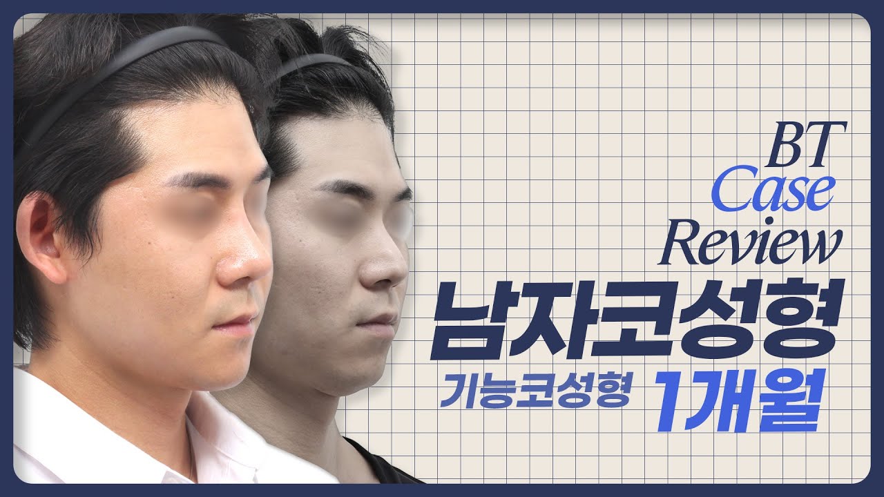 남자코성형 기능코성형 1개월차 케이스리뷰 ㅣ비티성형외과