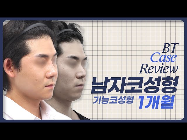남자코성형 기능코성형 1개월차 케이스리뷰 ㅣ비티성형외과