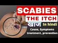 Scabies in hindi  the itch  cause symptoms treatment    msn  gnm  bsc nursing 2nd