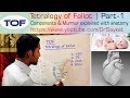 Tetralogy of Fallot (TOF) | Part 1 | Components & Murmur Explained | Dr. Saykat