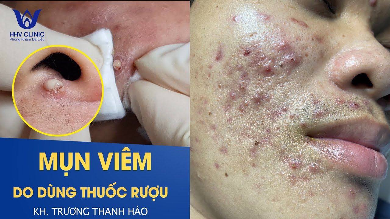 Trị mụn bằng thuốc rượu, mụn lây lan, viêm nhiễm | HHV Clinic | Đỗ Thu Hiền | KH Trương Thanh Hào