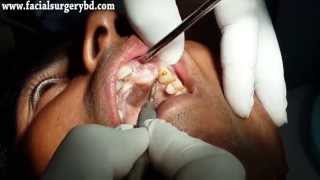 Dental Cyst Surgery (Palatally) in Bangladesh Done by Dr Abdullah Al Masud