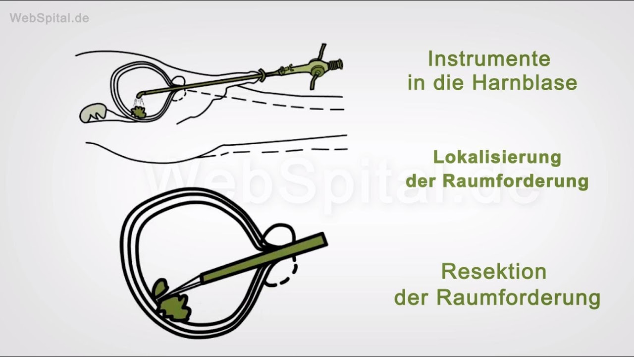 Lumbale Endplatten Osteophyten Resektion bei TLIF