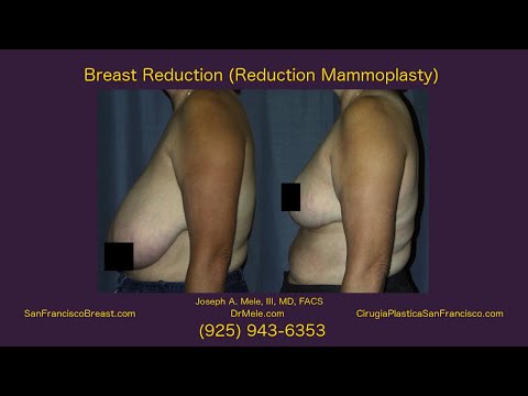 san francisco breast reduction Natural beach boob
