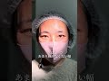 【二重整形】で毎日のアイテープから卒業!奥二重のまぶたからアイテープいらずの綺麗な二重に!