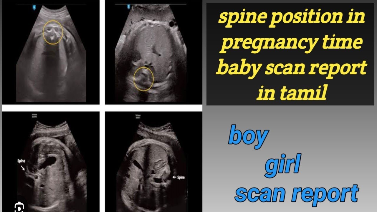 Boy and girl baby spine position in scan report 7th and 9th month ...
