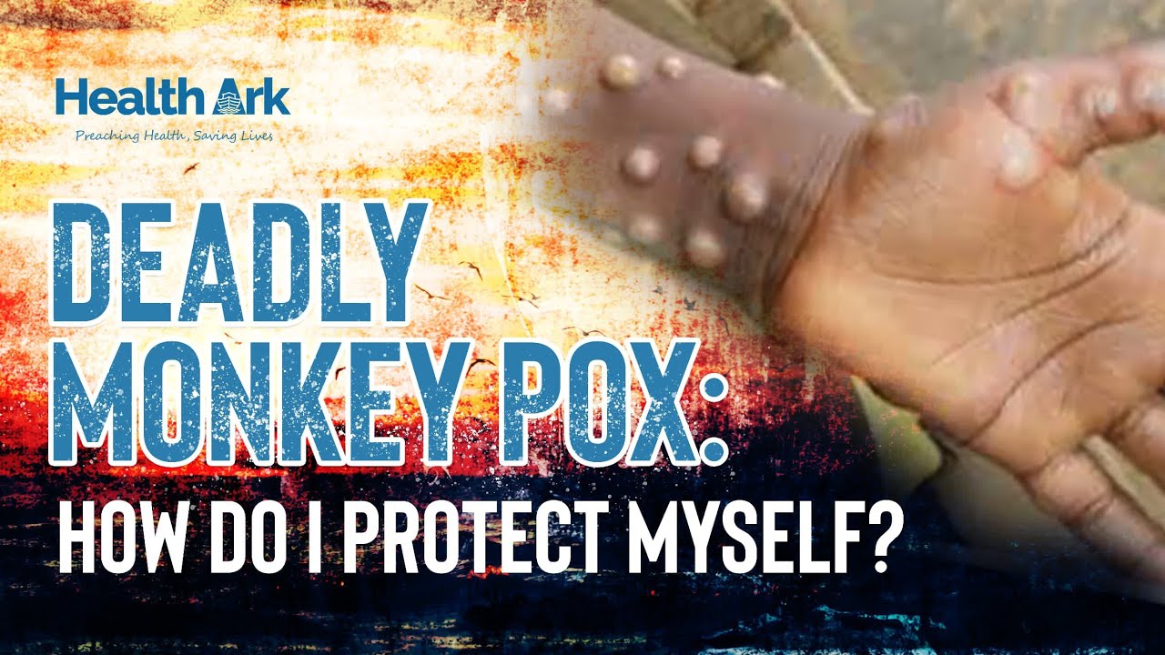 Monkeypox virus: Prevention and treatment options. 