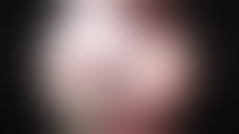 Type O Submucus Myoma