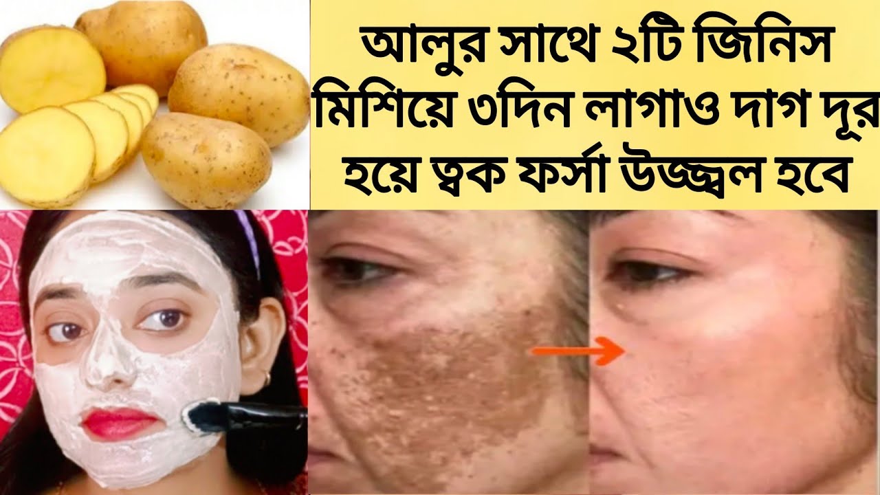 ত্বক হবে দাগহীন  ফর্সা  উজ্জ্বল গ্লোয়িং রাতে মাখো এই  আলুর ক্রিম /remove pigmentation /potato cream