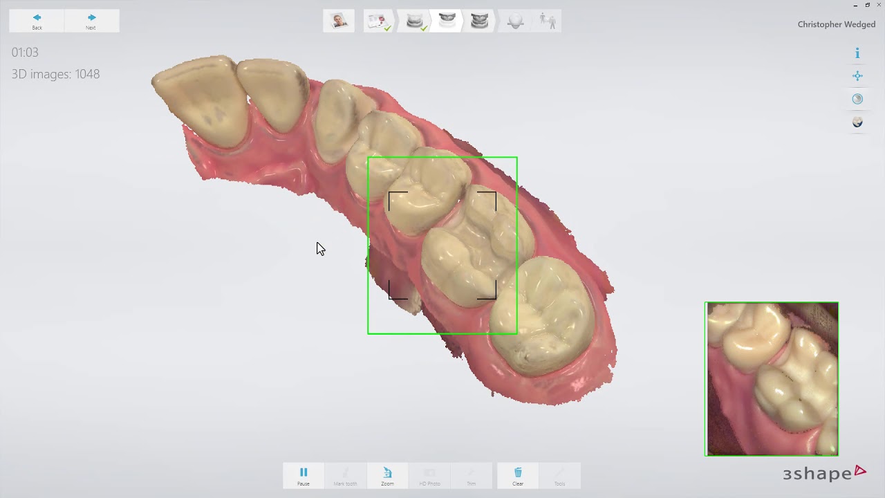 3Shape TRIOS - Inlay, Onlay, Veneer Workflow ES