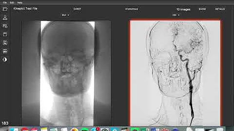 Kinepict - Make X-ray angiography safer!