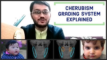 Cherubism Grading System | Dr Bhaumik Joshi | ASPIRE MDS | NEET | AIIMS