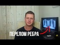 Как лечить перелом ребра?