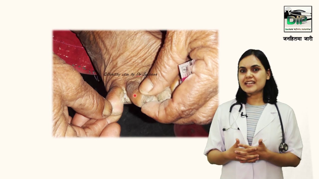 दाद Ringworm in Nepali छाला राेग विशेषज्ञ Dr. Suchana Marahatta