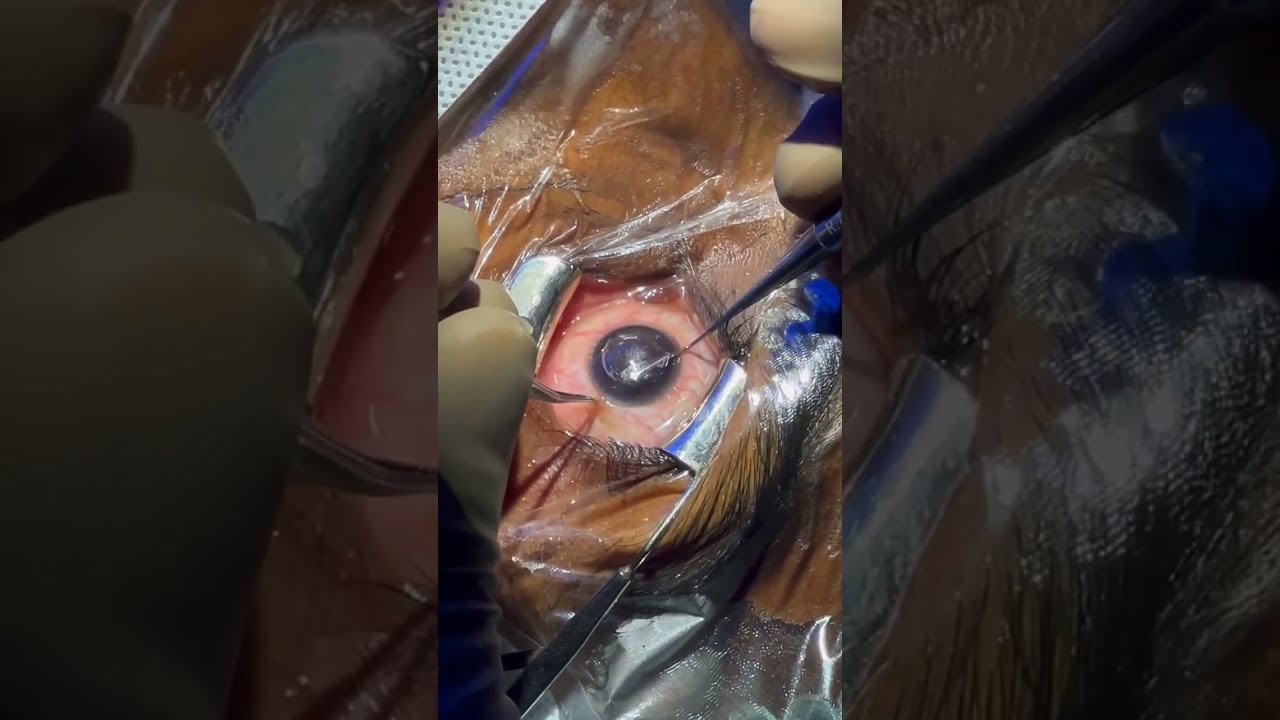 Smile Eye Surgery for -8 power patient!! #smile #eye #eyehospital #eyecare #eyesurgery #smilesurgery