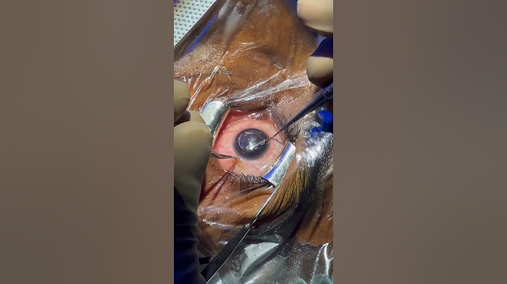 Smile Eye Surgery for -8 power patient!! #smile #eye #eyehospital #eyecare #eyesurgery #smilesurgery