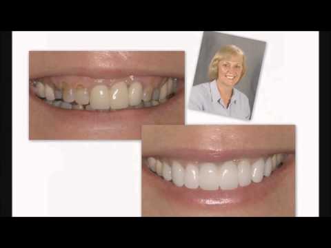 Old Dentistry Restored With Porcelain Veneers