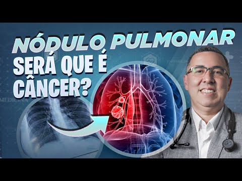 Nódulo no pulmão é câncer? Médico Pneumologista explica o que fazer nessa situação