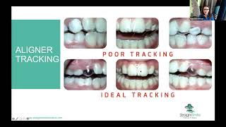 Posterior Open Bite and Aligners