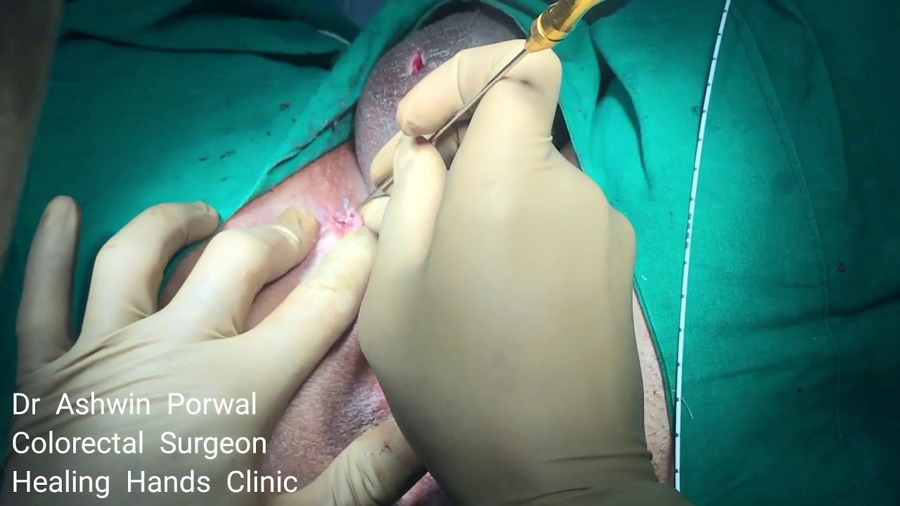 Ano-scrotal Fistula Treated by Dr Ashwin Porwal using Distal Laser Proximal Ligation hernia treatment in homeopathy in hindi