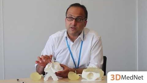 Using 3D printing for complex pediatric transplantation: an interview with Pankaj Chandak