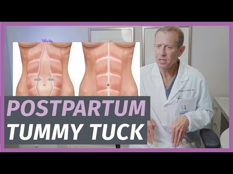 Postpartum Tummy Tucks: Everything You Need To Know