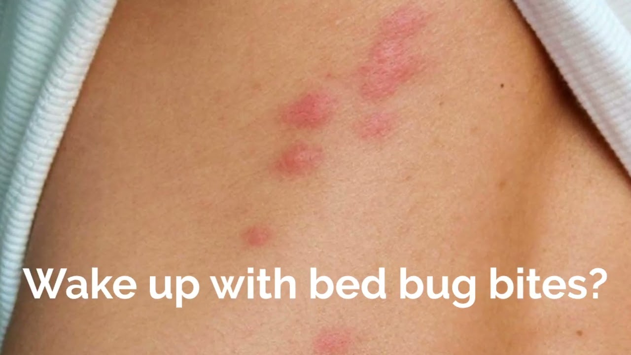 Wake Up With Bed Bug Bites YouTube Wake Up With Bed Bug Bites YouTube