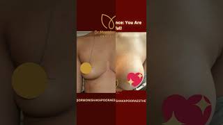 Breast Implant Surgery| Female Breast Surgeon| shorts trending new