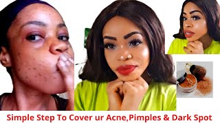 How To Cover Acne, Pimples & Dark Sport Perfectly with simple step