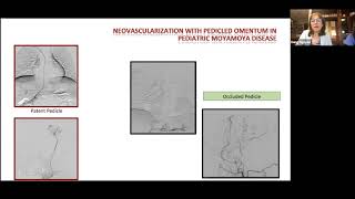 Drs. Nguyen & Wapnir: Omentum-based Breast Reconstruction