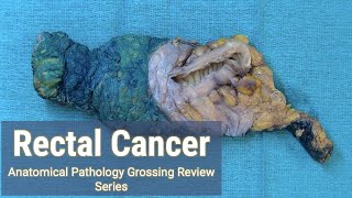 Rectal Cancer + Lymph Node Hunt | Anatomical Pathology Grossing Review Series